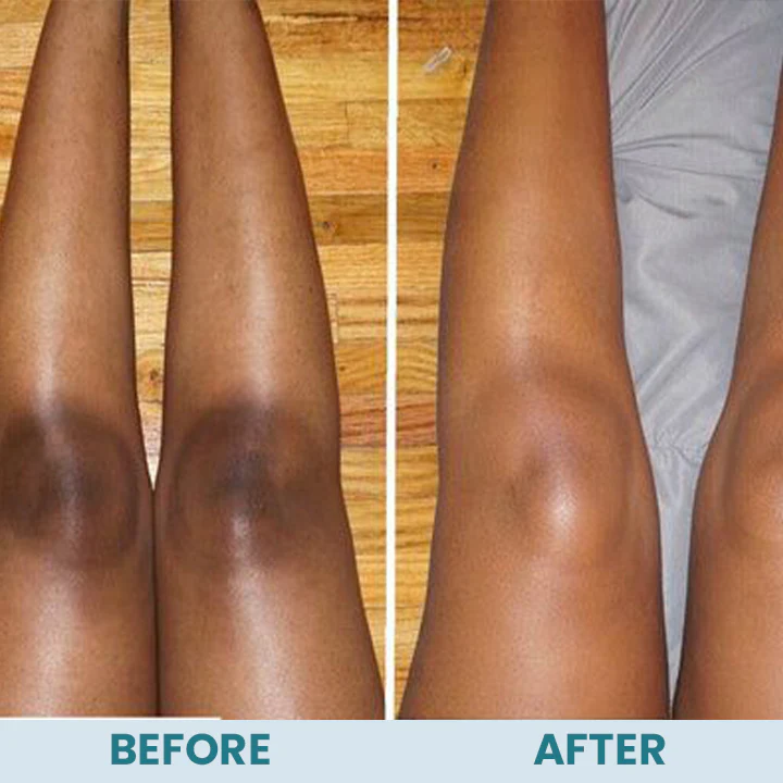 LIMETOW™ Acanthosis Nigricans Therapy Cream - Image 8