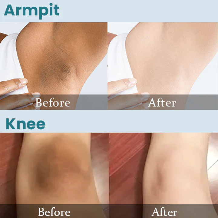 LIMETOW™ Acanthosis Nigricans Therapy Cream - Image 6