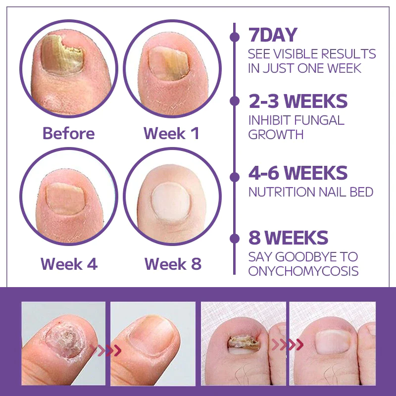 Fivfivgo™ Anti-Pilz-Nagelspray - Image 7