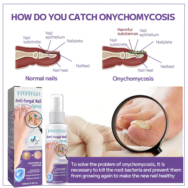 Fivfivgo™ Anti-Pilz-Nagelspray - Image 4