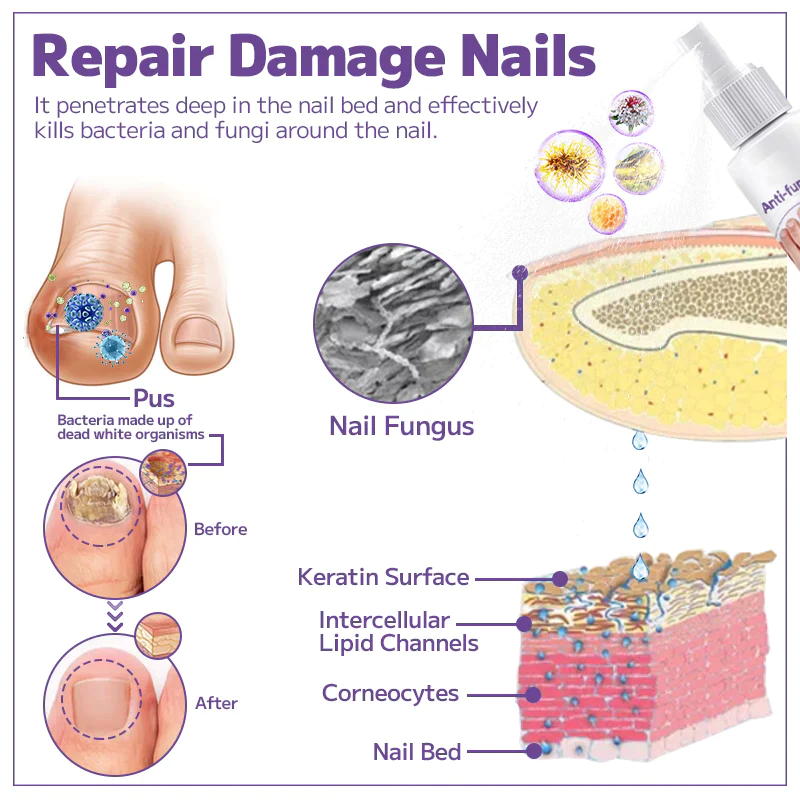 Fivfivgo™ Anti-Pilz-Nagelspray - Image 3