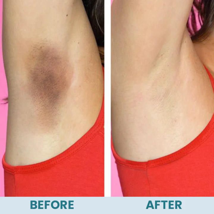 LIMETOW™ Acanthosis Nigricans Therapy Cream - Image 7