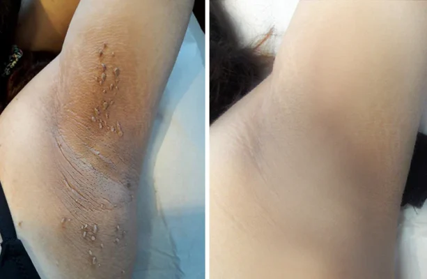 Ceoerty™ Bee Venom ClearSkin Wart and Tags Removal Treatment Spray - Image 7