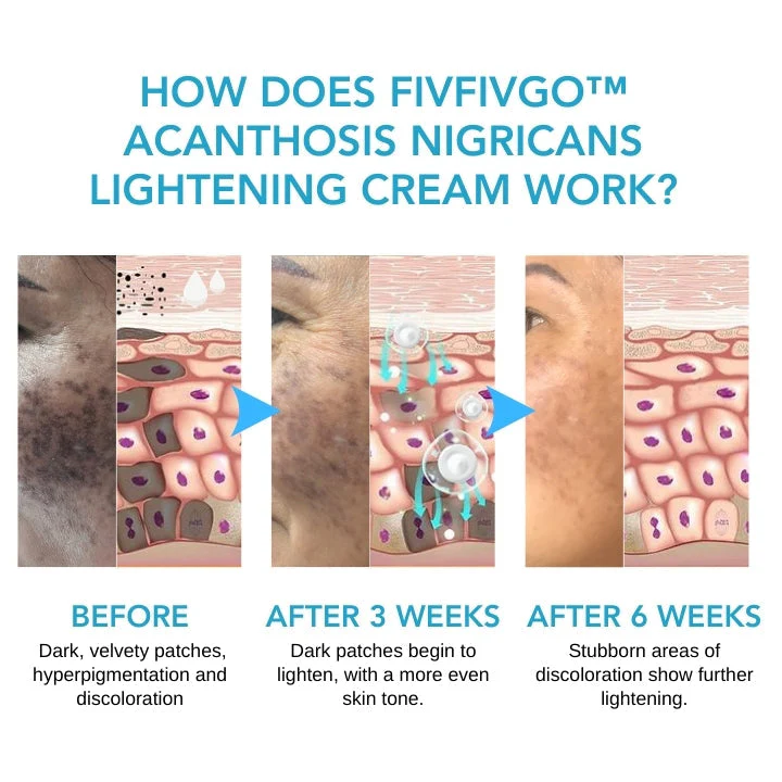 Fivfivgo ™ Acanthosis Nigricans Aufhellungscreme - Ìomhaigh 5