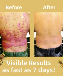 Alternative view of LOVILDS® Bee Venom Psoriasis Treatment Cream