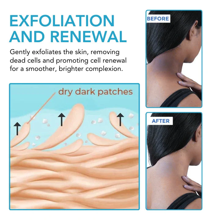 Fivfivgo ™ Acanthosis Nigricans Aufhellungscreme - Ìomhaigh 6