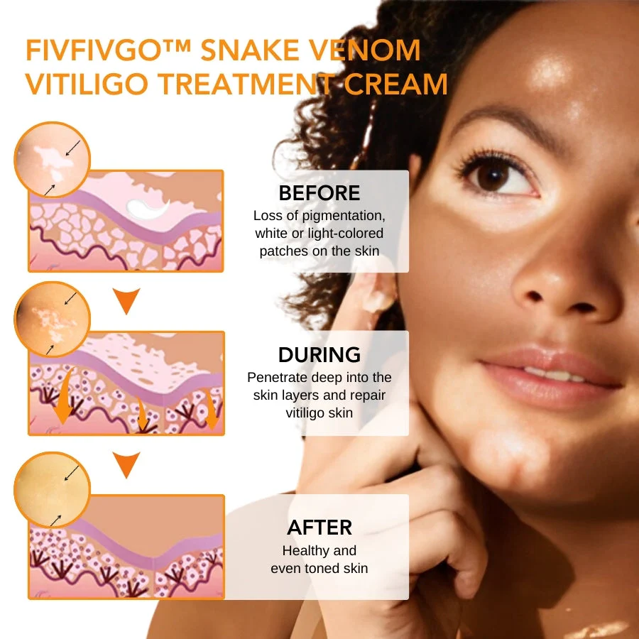 Fivfivgo™ Schlangengift Vitiligo Behandlung Creme - Image 7