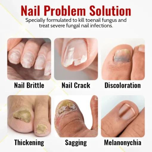 Biancat™ Japanilainen NailRenew Onychomycosis Swift Relief Oil - Kuva 5