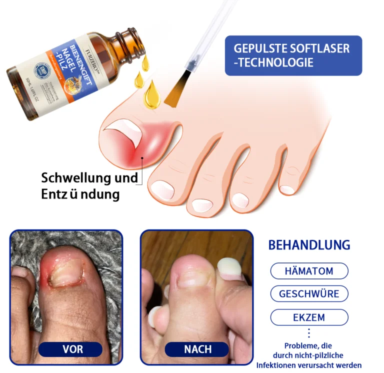 Furzero™ Bienengift Nagelpilz Behandlungslösung - Image 15