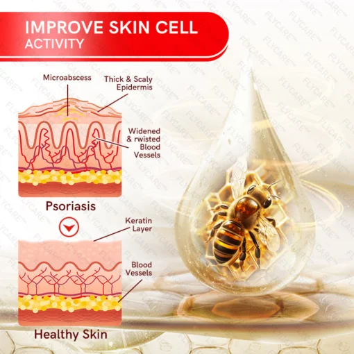 FLYCARE™ Bee Venom Multi-Symptom Psoriasis Cream - Image 8