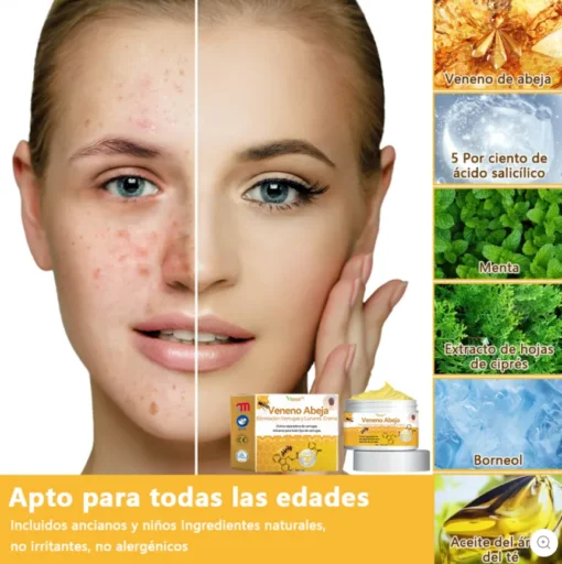 𝑽𝒔𝒐𝒙𝒂™ 𝑽𝒆𝒏𝒆𝒏𝒐 𝑨𝒃𝒆𝒋𝒂 𝑬𝒍𝒊𝒎𝒊𝒏𝒂𝒄𝒊ó𝒏 𝑽𝒆𝒓𝒓𝒖𝒈𝒂𝒔 𝒚 𝑳𝒖𝒏𝒂𝒓𝒆𝒔 𝑪𝒓𝒆𝒎𝒂 - Image 6