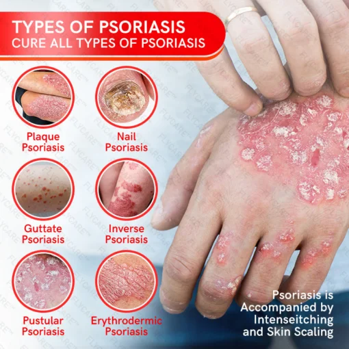 FLYCARE™ Bee Venom Multi-Symptom Psoriasis Cream - Image 6