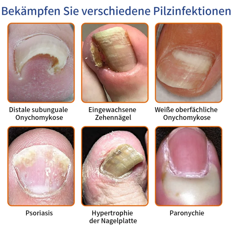 Furzero™ Bienengift Nagelpilz Behandlungslösung - Image 12