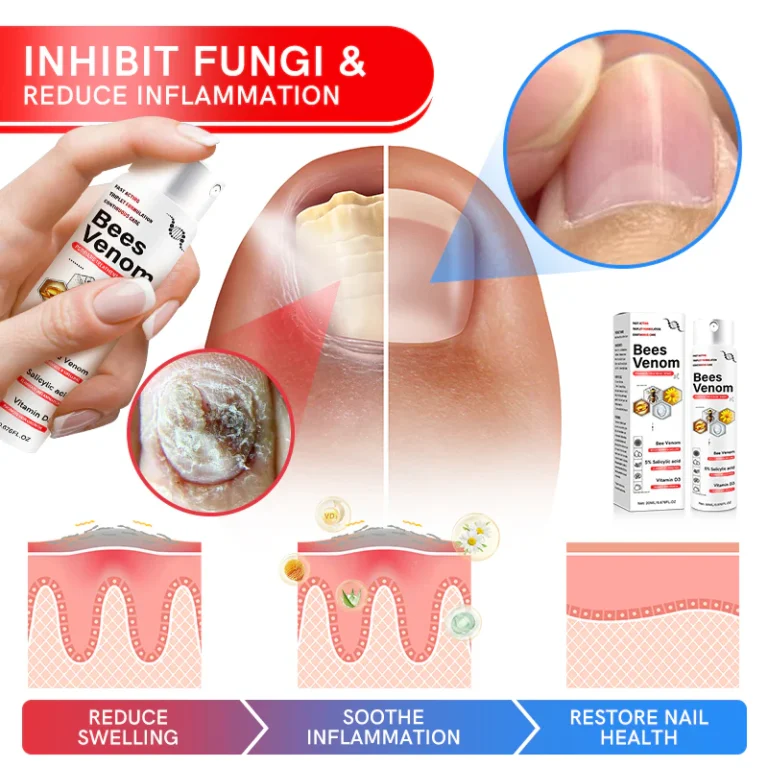 Furzero™ Multi-Symptom Bee Venom Psoriasis Treatment Spray - Image 4