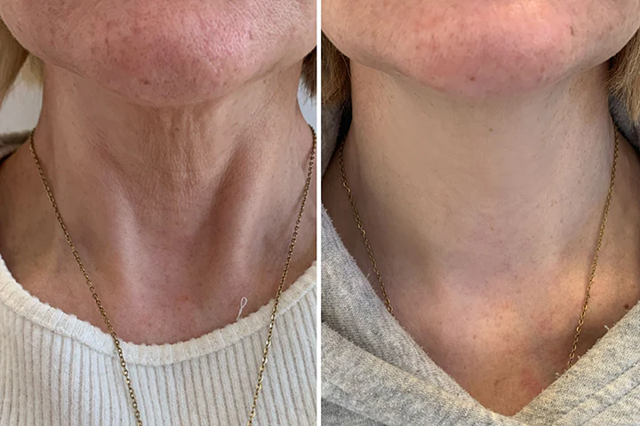 बियांकाट™ यूथगार्ड अल्टीमेट नेक लिफ्ट क्रीम - छवि 8