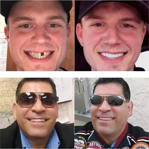 Tiworld™ Adjustable Snap-On Dentures - Image 4