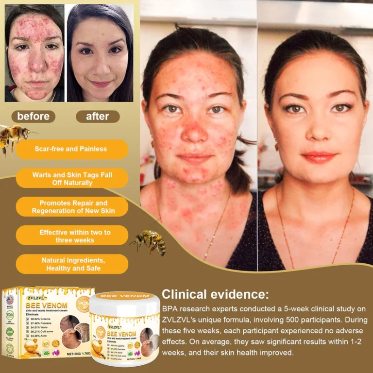 Turonu™ Bee Venom Wart and Skin Tag Treatment Cream - Image 3