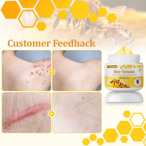 LOVILDS™ TagCure Bee Venom Wart & Moles Removal Cream - Image 8