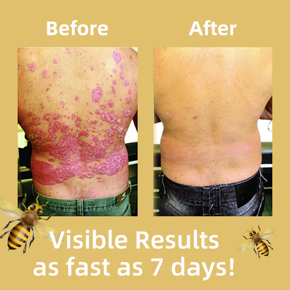 Velisse™ Psoriasis Removal Antibactorial Cream - Image 3