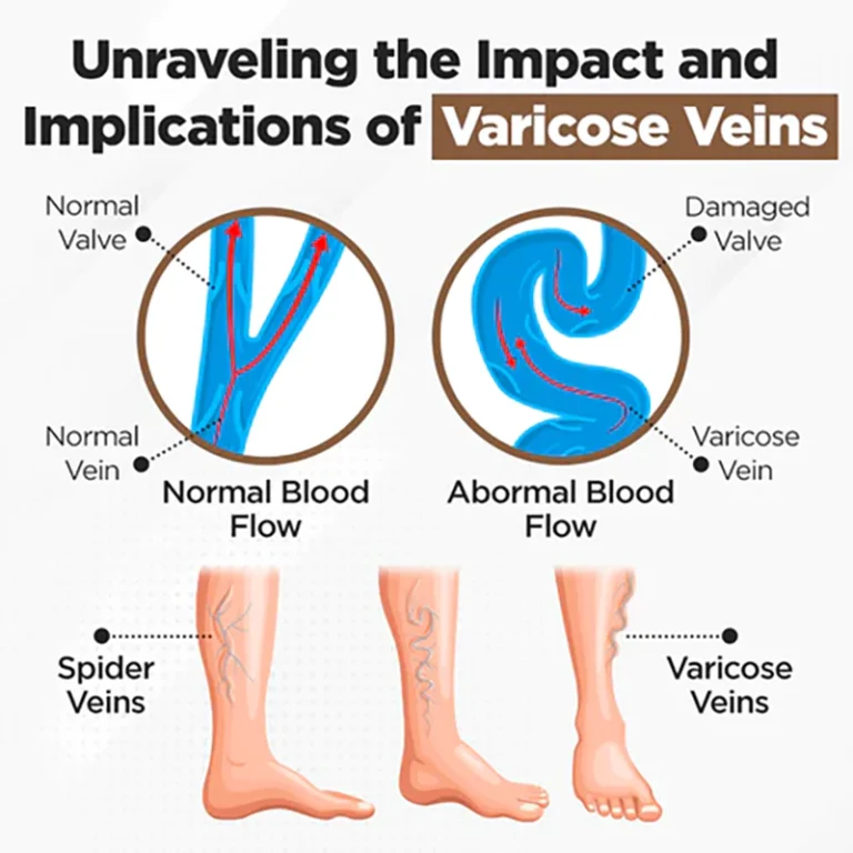 RAINDEW™ Leech Varicose Vein Cream - Image 6