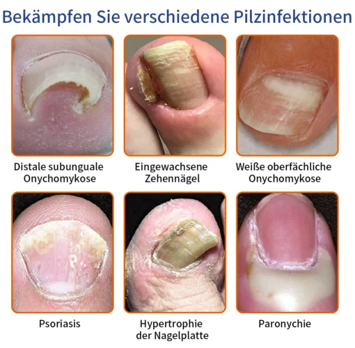 Furzero™ Bee Venom Nail Fungus Treatment Solution - Image 6