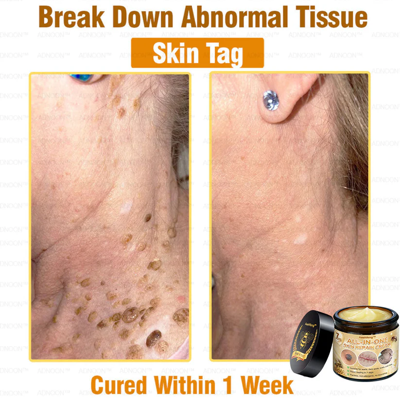 Aeehfeng™ 7-Day Rapid Skin Repair Cream is dermatologist-recommended for psoriasis and eczema.