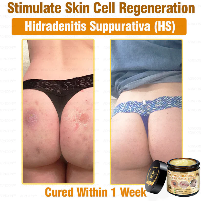 Aeehfeng™ 7-Day Rapid Skin Repair Cream stimulates natural skin healing.