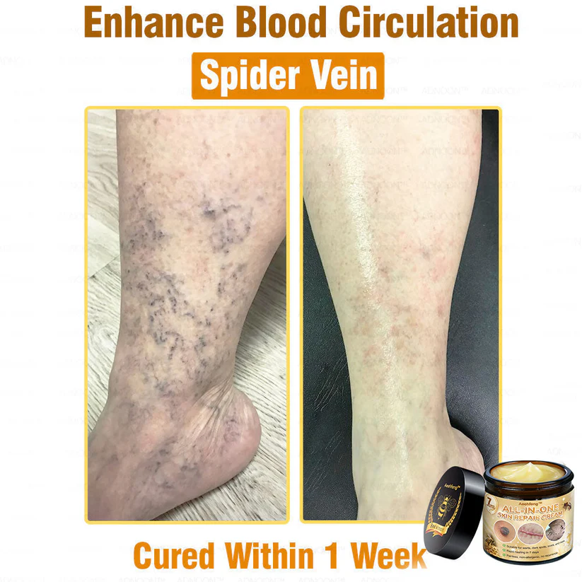 Remove skin tags effectively with Aeehfeng™ 7-Day Rapid Skin Repair Cream.