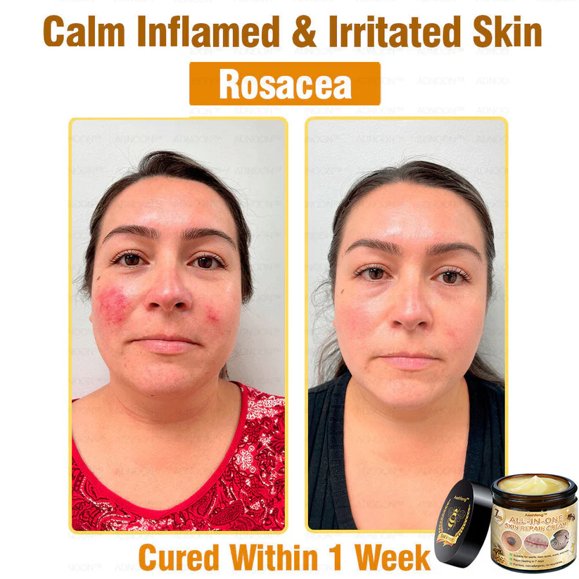 Treat eczema and psoriasis with Aeehfeng™ 7-Day Rapid Skin Repair Cream.