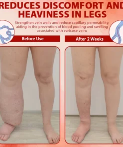 ApisHeal™ ApisVenom EdemaSupport Lymphatic Detox Cream reduces fluid buildup and enhances drainage.