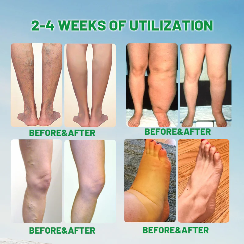 LOVILDS™ Royal Jelly MushroomVanish Foot Treatment Spray speeds up fungal infection recovery.