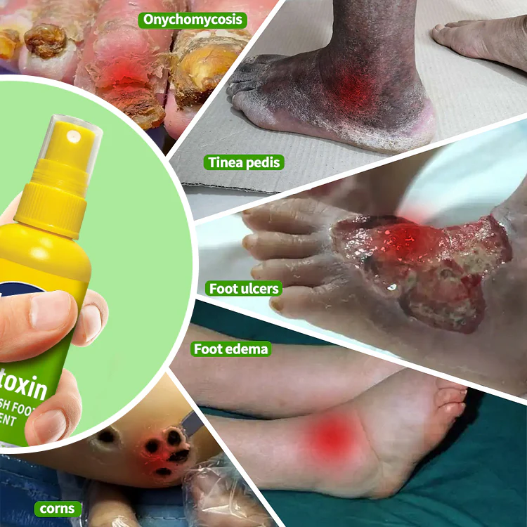 LOVILDS™ Royal Jelly MushroomVanish Foot Treatment Spray reduces dryness and cracking on feet.