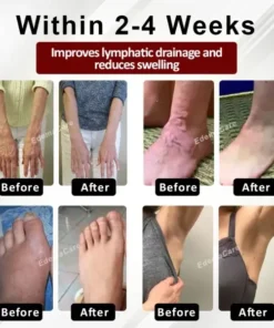 EdemaCare™ Horse Chestnut VenoLymph Massage Cream