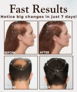 Hairgenz™ Hair Regrowth Capsules