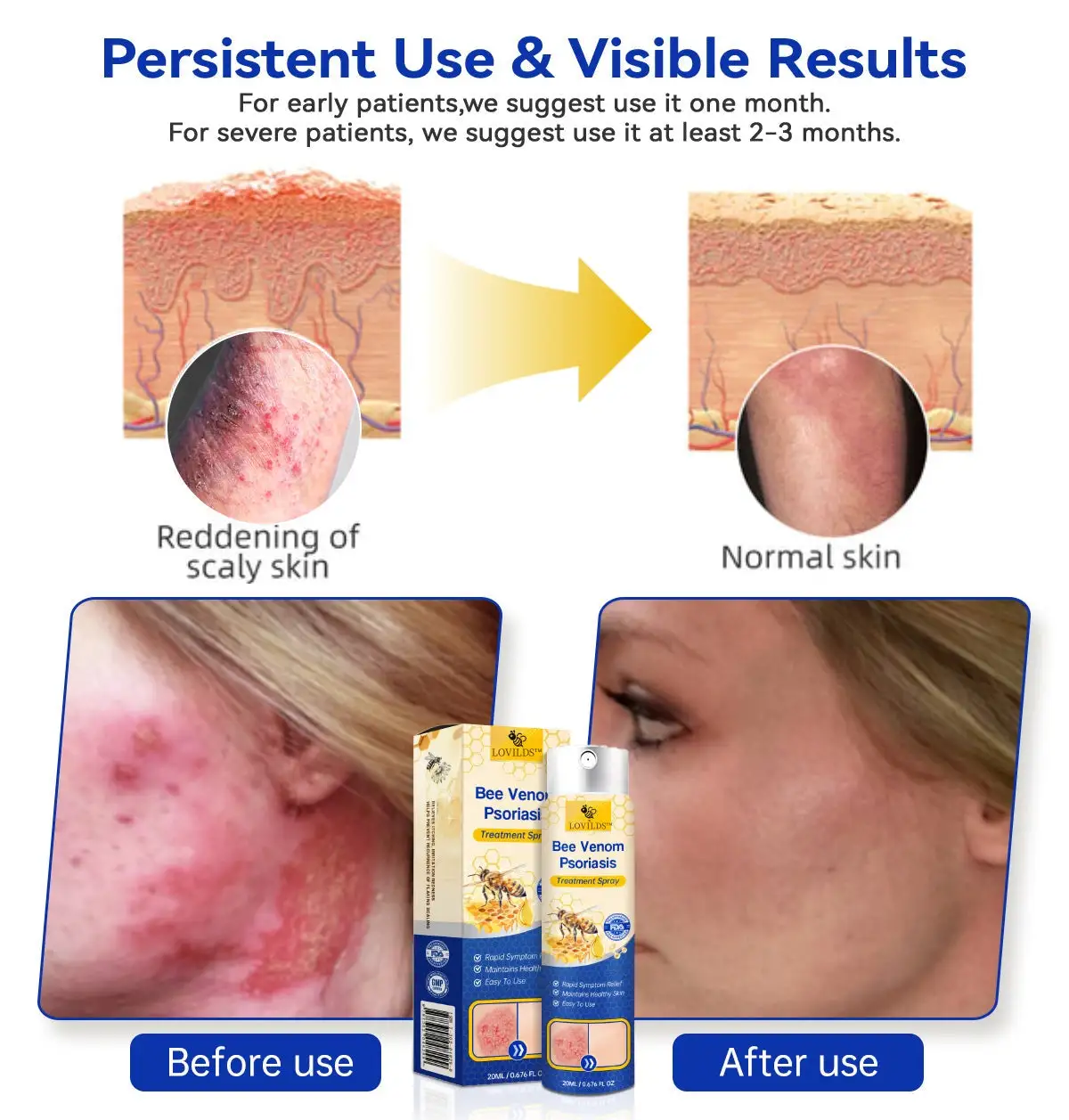LOVILDS™ PsoriaHeal psoriasis Spray