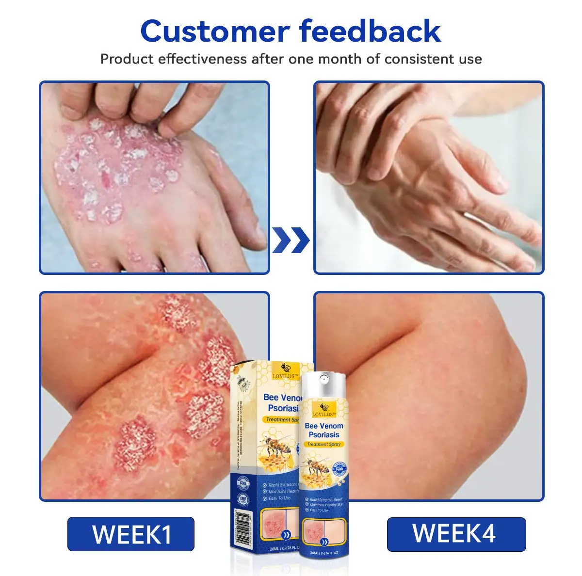 LOVILDS™ PsoriaHeal psoriasis Spray
