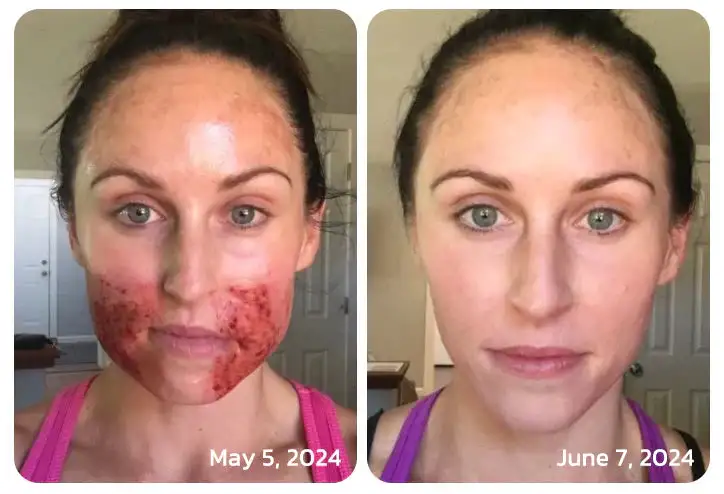 LOVILDS™ PsoriaHeal psoriasis Spray