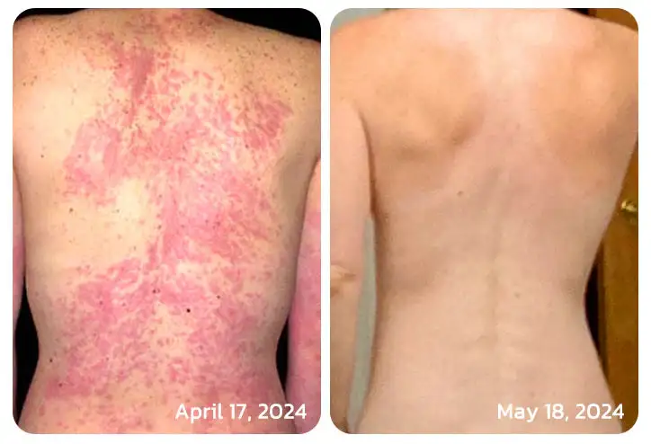LOVILDS™ PsoriaHeal psoriasis Spray