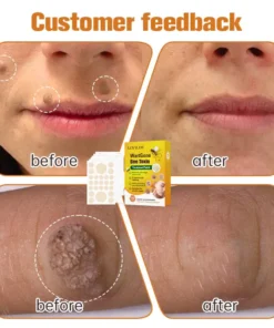 LOVILDS™ WartGone Bee Venom Treatment Patch (150PCS/PACK)