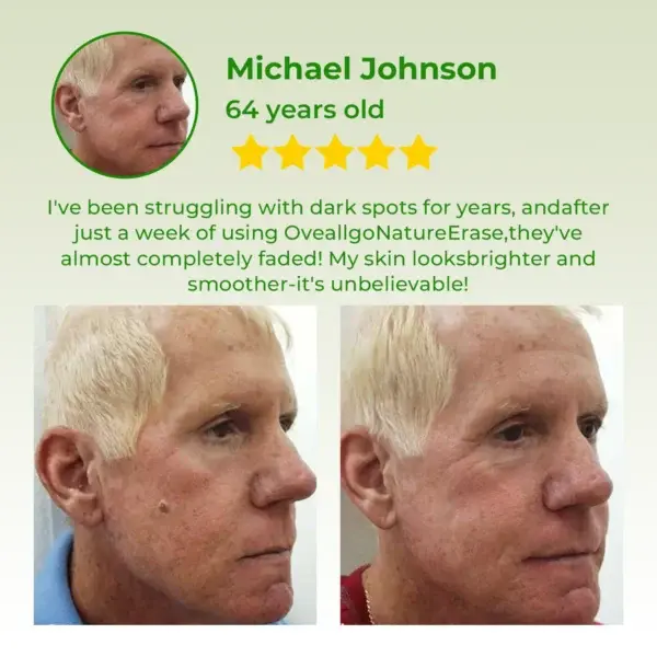 ✅ Official Store: Dobshow™ NatureErase Instant Mole & Spot Cream