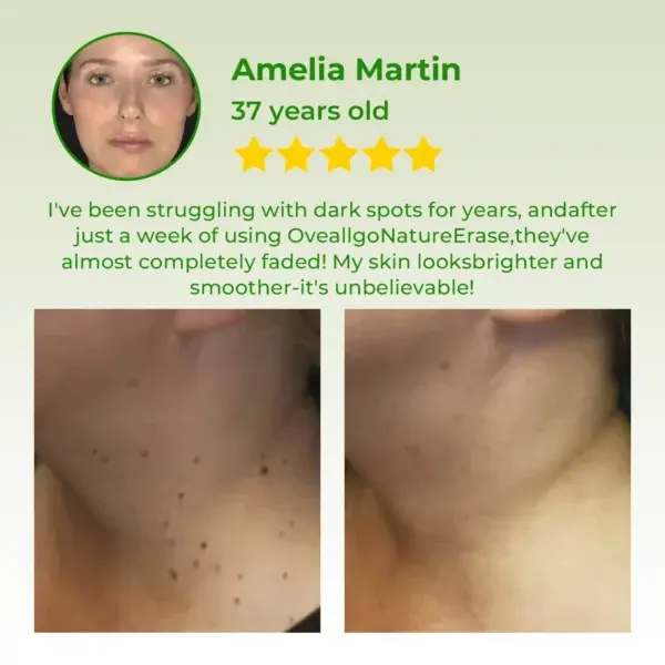 ✅ Official Store: Dobshow™ NatureErase Instant Mole & Spot Cream