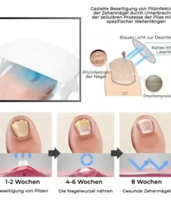 Fivfivgo™ Revolutionäres Lichttherapiegerät für Zehennagelkrankheiten
