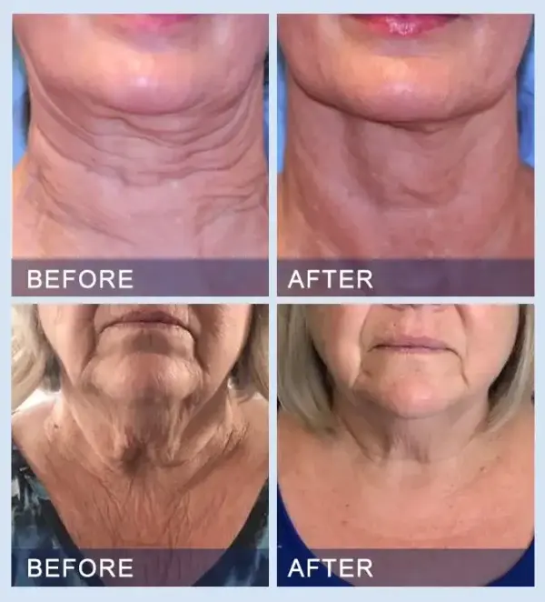 Serum togail is daingnichte Furzero ™ uile-ann-aon