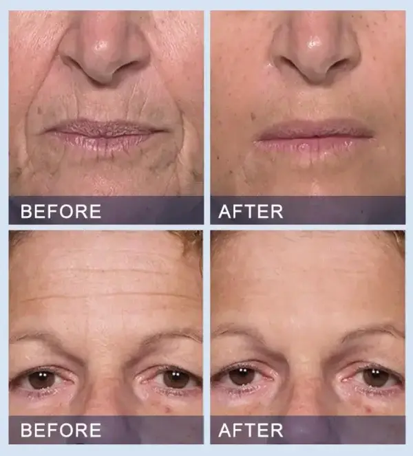 Serum togail is daingnichte Furzero ™ uile-ann-aon