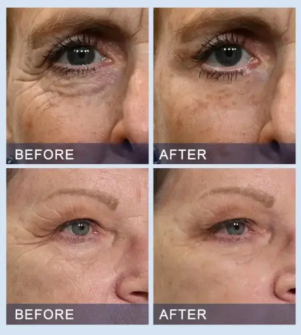 Serum togail is daingnichte Furzero ™ uile-ann-aon