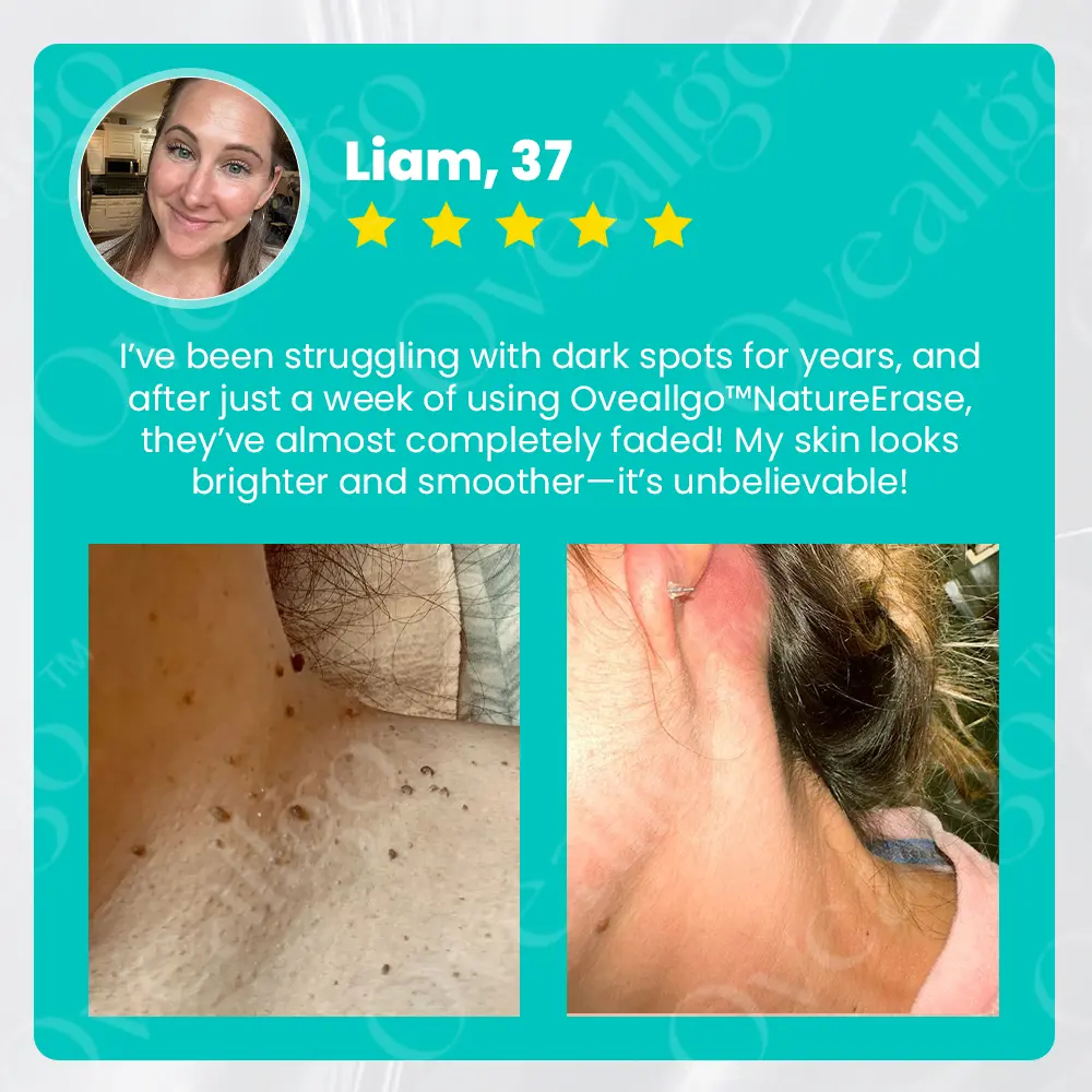 Lovilds™ NatureErase Instant Mole & Spot Cream