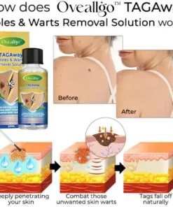 Oveallgo™ TAGAway Moles & Warts Removal Solution