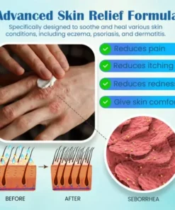 Seurico™ Eczema Psoriasis Cream