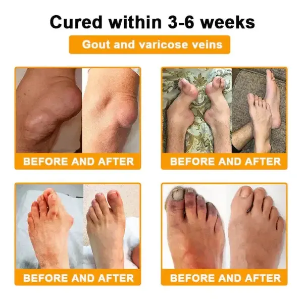 ADNOON™ Botulinum Toxin & Bee Venom Pain-Relief Bone Healing Cream