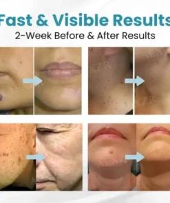 Bikenda® Non-Invasive Mole and Wart Removal Laser Pen